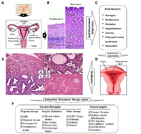 definiție endometrială hiperplazie